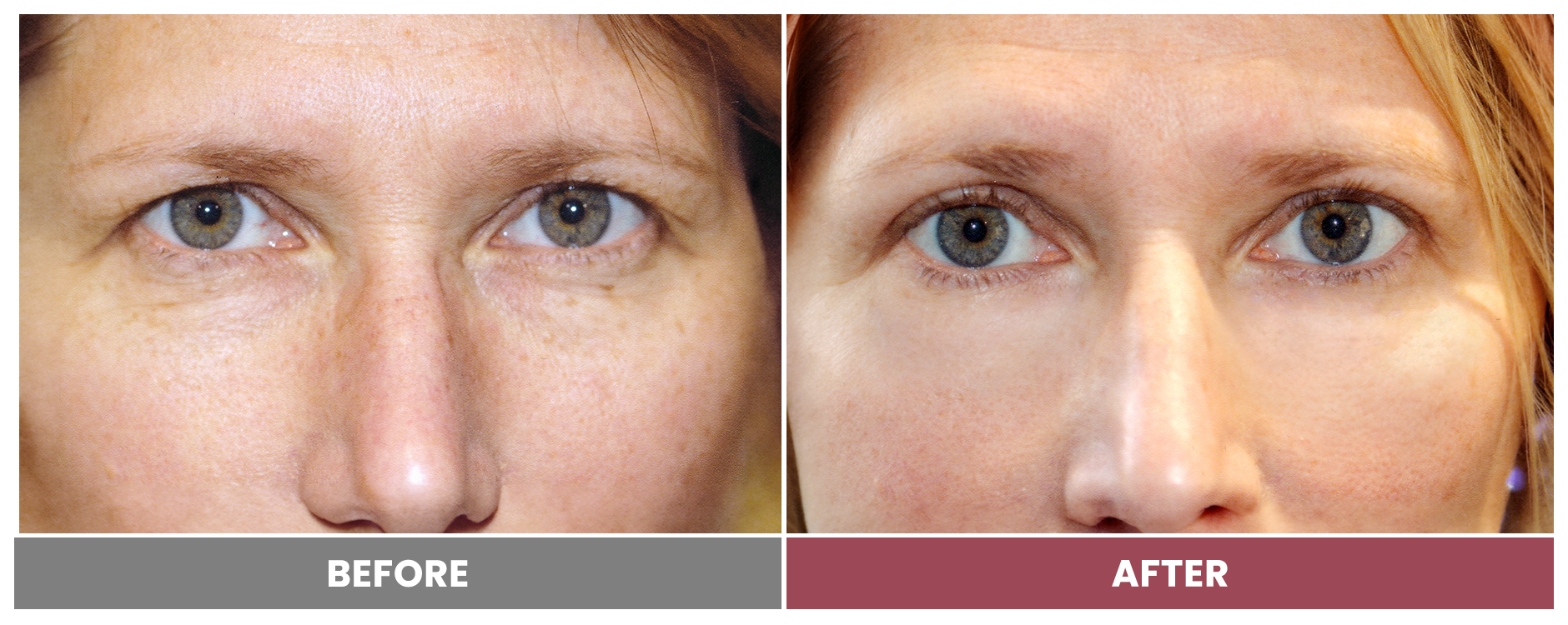 Upper Blepharoplasty - Case 88